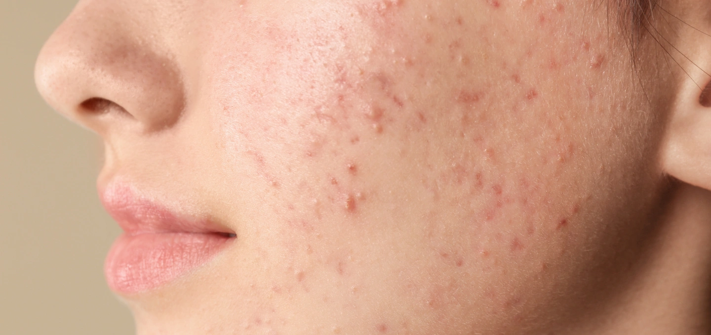 Acne Patient Cambridge