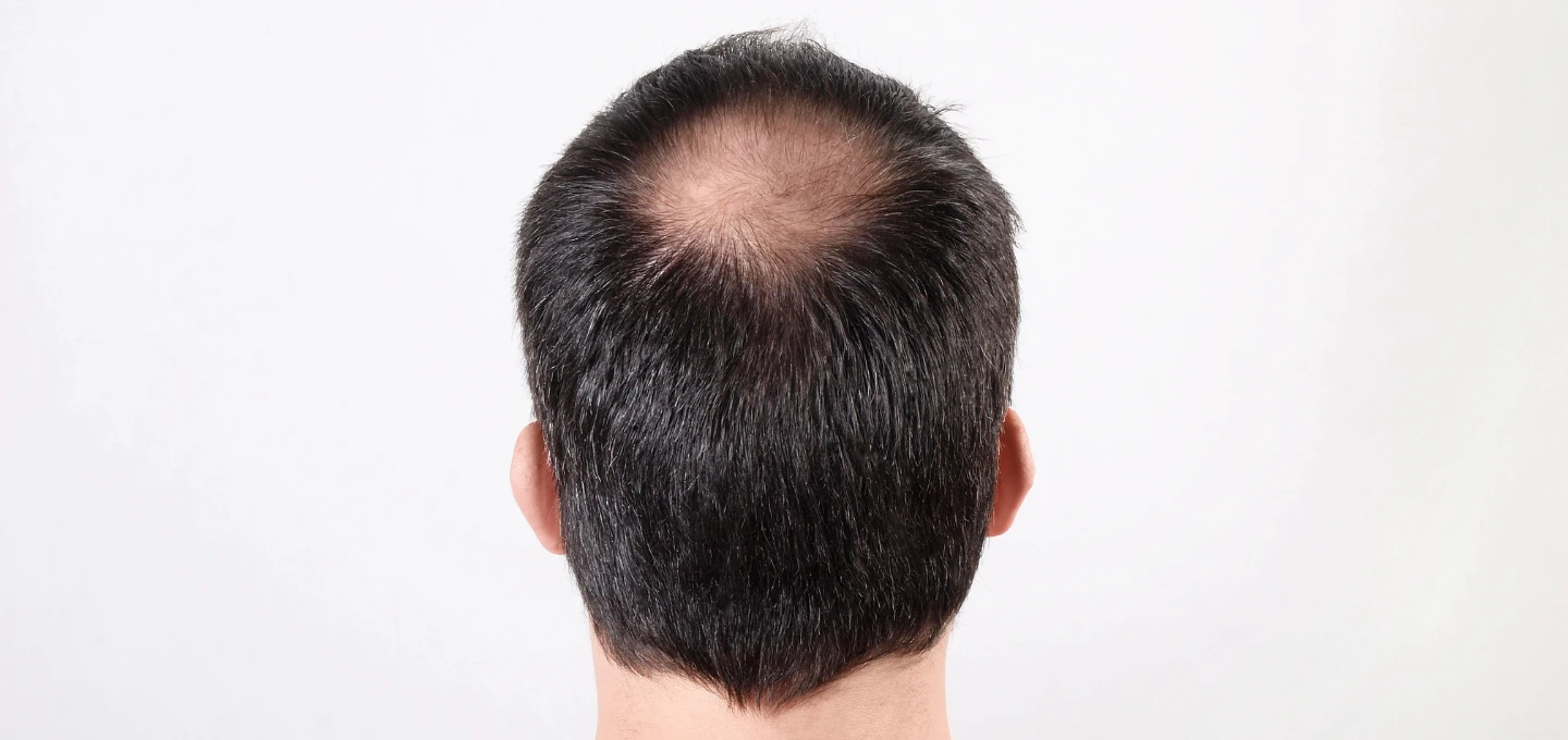hair loss Cambridge patient