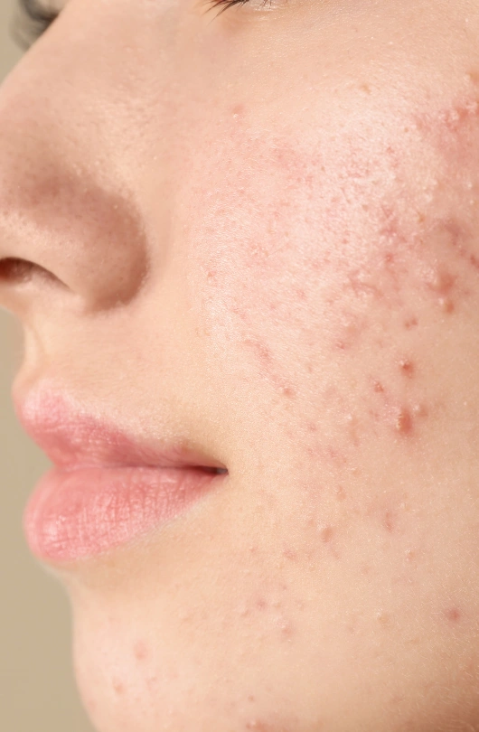 Acne Patient Cambridge