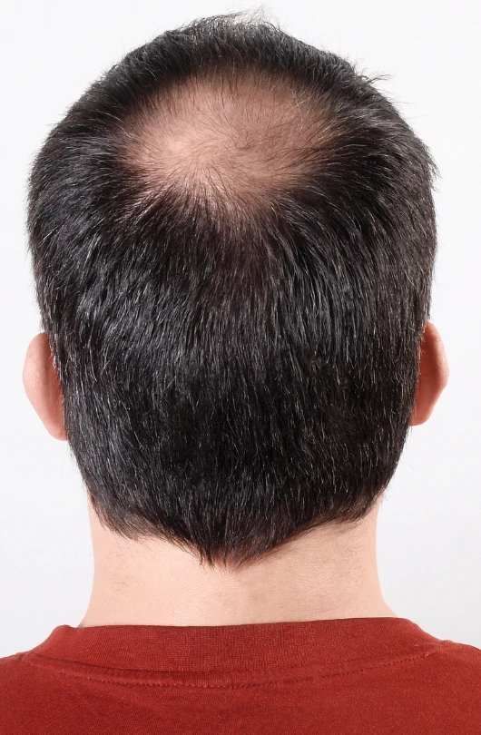 hair loss Cambridge patient