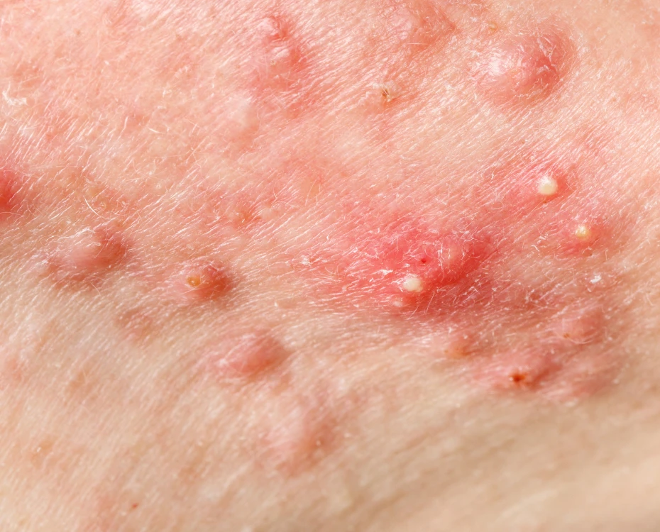 close up of one of our client acne breakouts